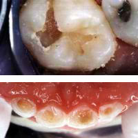 Kariesschäden im Babyalter beeinflussen die gesamte Entwicklung der Zähne.